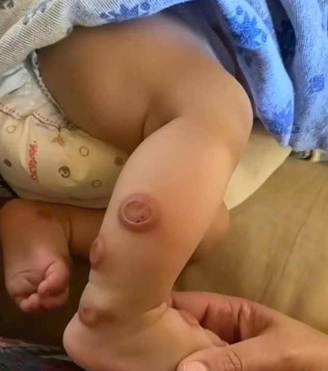 Unseen Danger: How a Common Inhaler Uncovered a Case of Sweet’s Syndrome